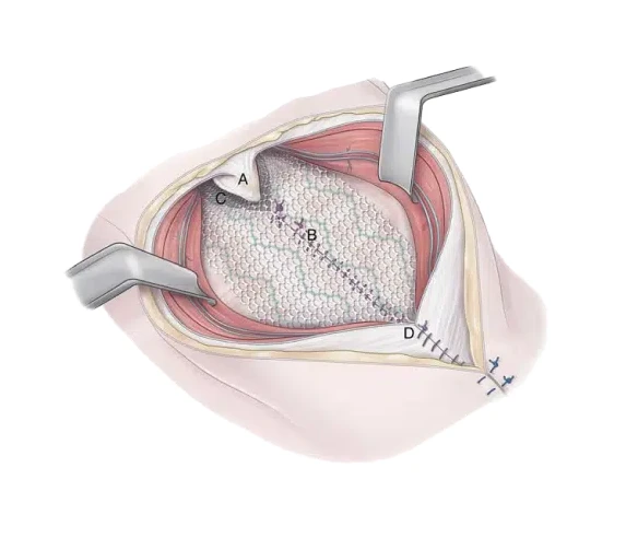 Hernia Mesh